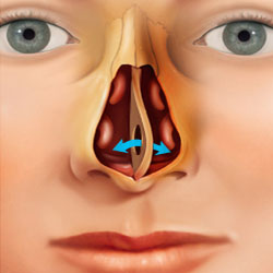 Septum Perforasyonu Onarımı — bilgilendirici görsel