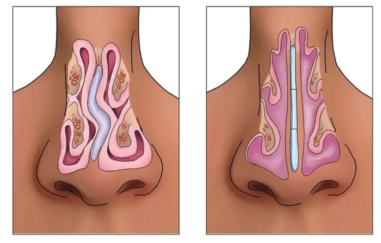 Septum Deviasyon Ameliyatı — bilgilendirici görsel