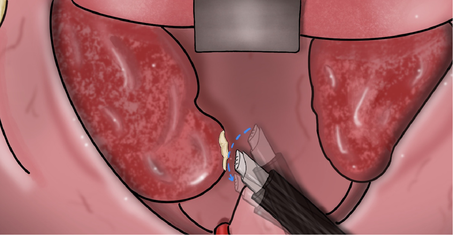 Bademcik (tonsil) küçültme — bilgilendirici görsel
