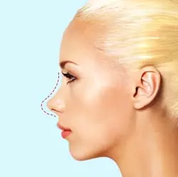 Rinoplastica «Barbie» — immagine informativa